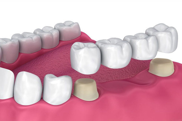 روکش و بریج دندان چیست؟