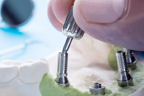 شل شدن پیچ در پروتزهای ایمپلنت دندانی
