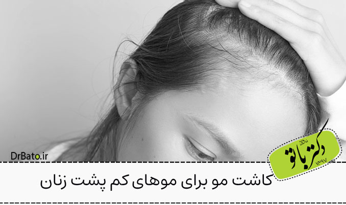 کاشت مو برای موهای کم پشت زنان